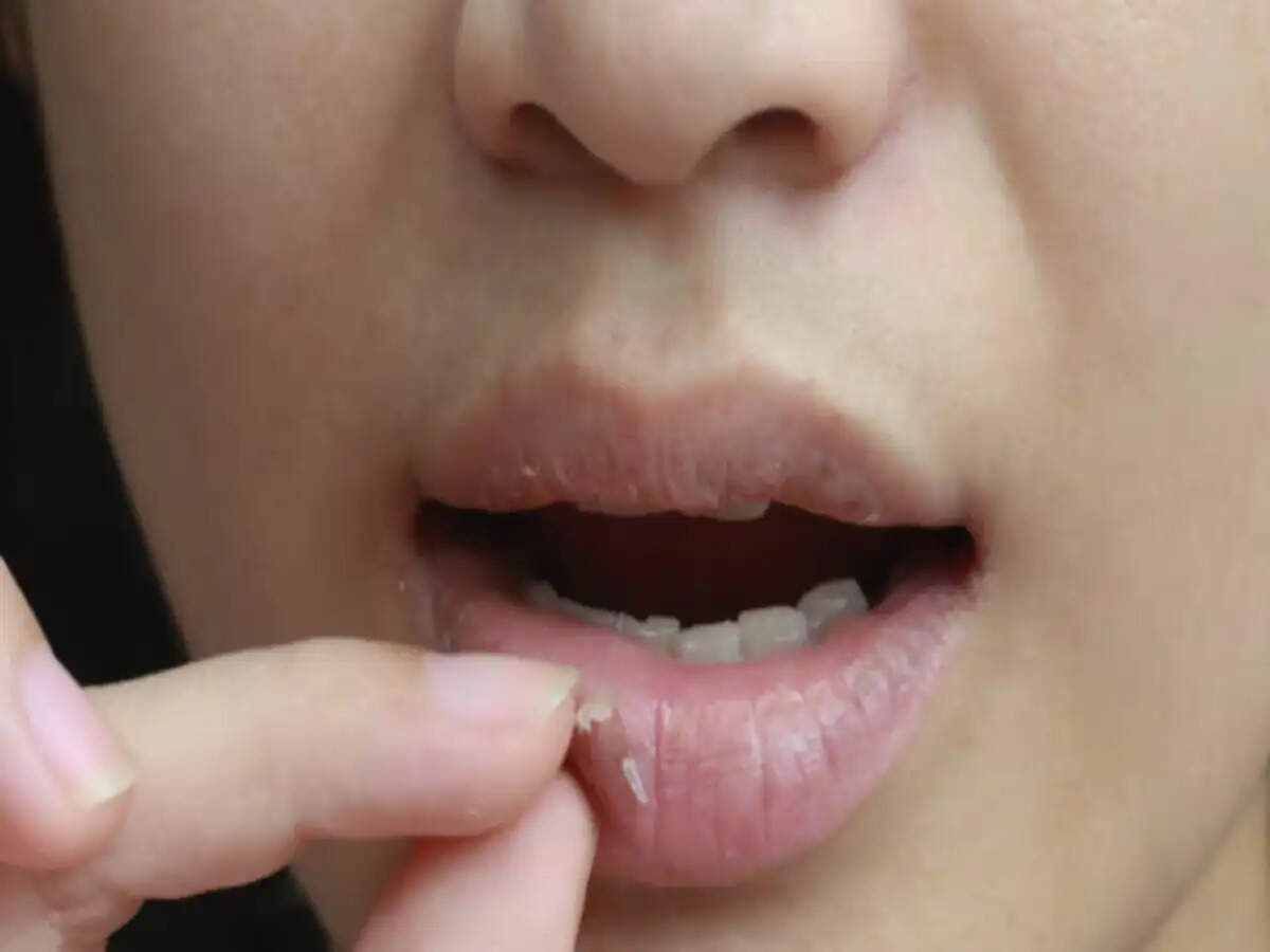 Crack Lips Tips- सर्दी के कारण आपके होंठ फट गए हैं, सही करने के लिए अपनाएं ये टिप्स