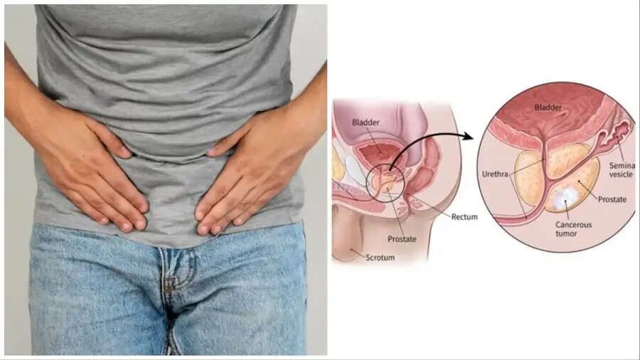 Health Tips- अगर बचना चाहते हैं प्रोस्टेट कैंसर से, तो अपनाए ये टिप्स