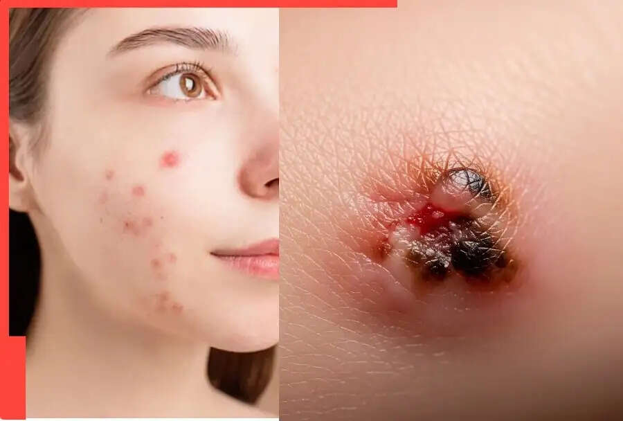 Health Tips-&nbsp;स्किन कैंसर से मामले बढ़ रहे है, इन संकेतों का ना करें नजरअंदाज
