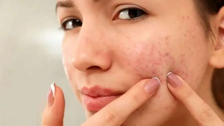 Skin Care Tips-&nbsp;क्या चेहरे पर होने वाले लाल दानों से परेशान हैं, तो आजमाएं ये देसी घी वाला नुस्खा