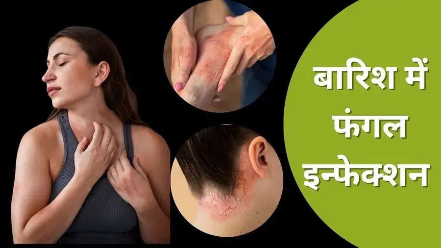 Health Tips-&nbsp;क्या बारिश में स्किन इंफेक्शन ने कर दिया परेशान, तो ऐसे करें बचाव