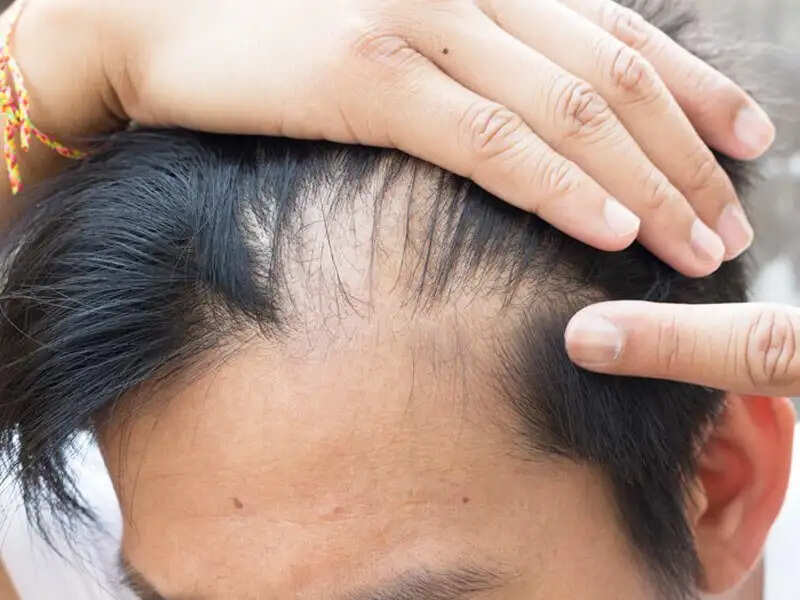 Hair Care Tips- क्या कम उम्र ही आपके बाल झड़ रहे हैं, यह गलतियां हो सकती हैं कारण