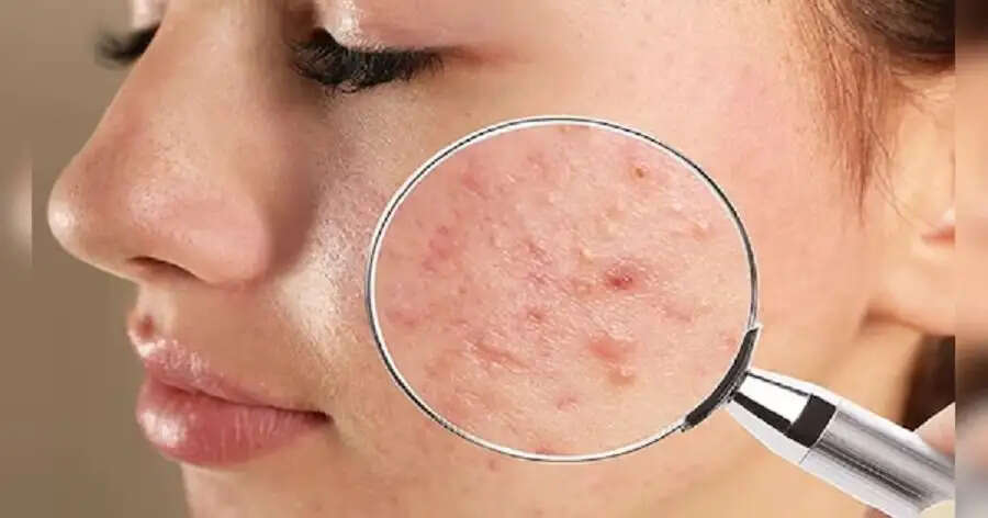 Pimple Tips- क्या पिंपल पर थूक लगाना सही हैं या गलत, आइए जानते हैं इसकी पूरी डिटेल्स