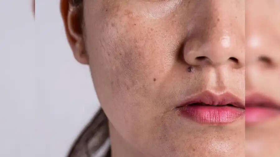 Skin Care Tips-&nbsp;क्या उम्र से पहले चेहरे पर झाइयों ने कर रखा है परेशान, तो लगाए ये 1 चीज