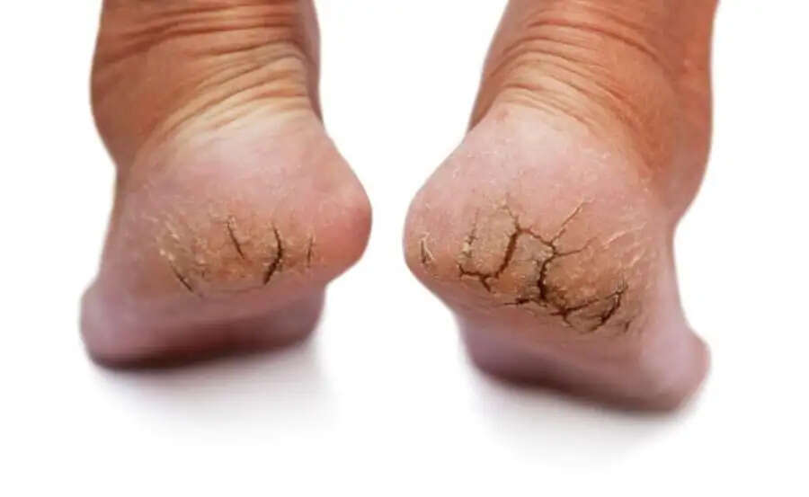 Ankle Tips- क्या ठंड आते ही आपकी ऐड़ियां फटने लग जाती हैं, तो अपनाएं ये घरेलू उपाय