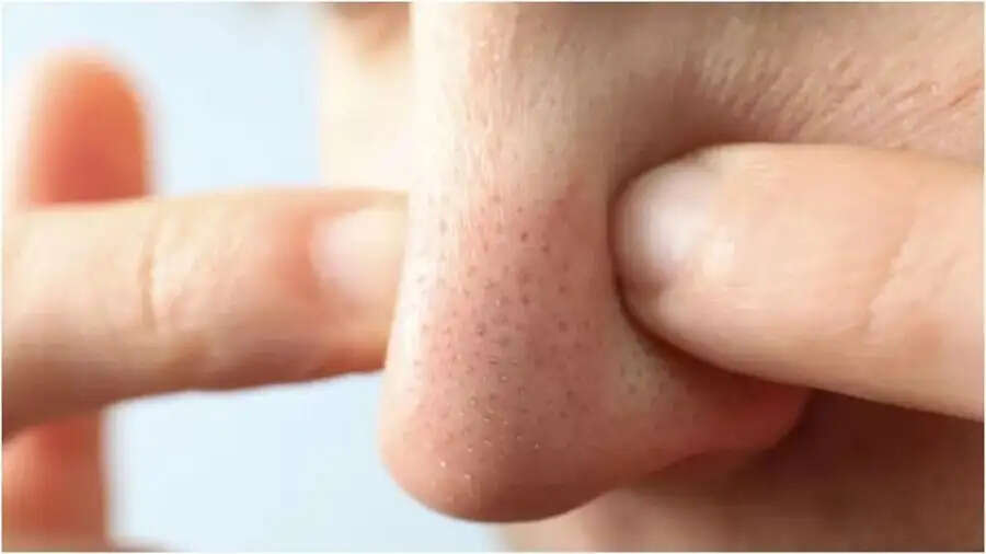 Skin Care Tips-&nbsp;व्हाइटहेड्स को जड़ से खत्म करने के लिए अपनाएं ये टिप्स, चेहरा बन जाएगा चमकदार