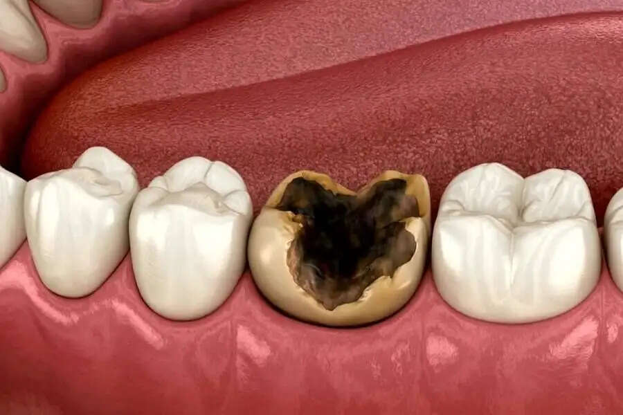 Teeth Care Tips- दांतों की सड़न ने कर रखा हैं परेशान, जानिए इसका कारण