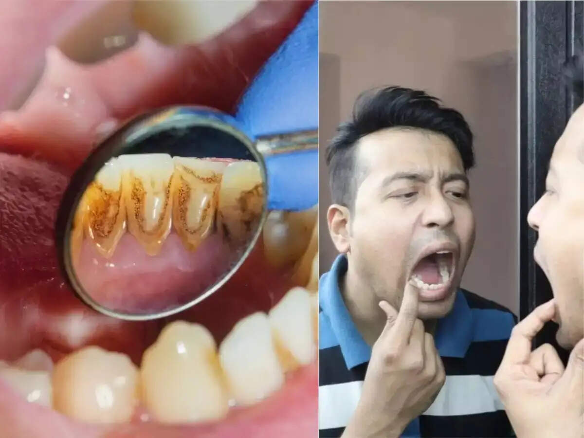 Teeth Care Tips- दांतों में जमे प्लाक को हटाना चाहते हैं, तो अपनाएं ये घरेलू टिप्स