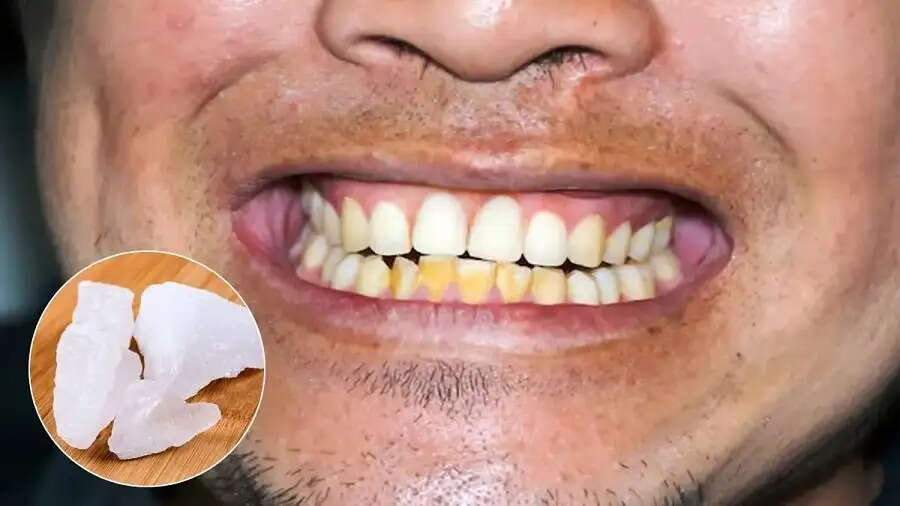 Teeth Care Tips- क्या दांतों के पीलेपन ने कर रखा हैं परेशान, साफ करने के लिए फिटकरी का करें इस्तेमाल