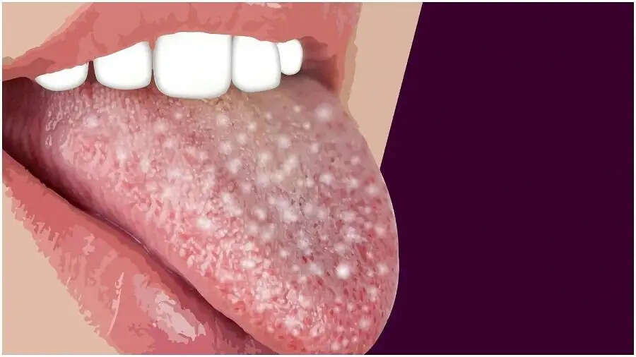 Health Tips- आपकी जीभ बताती हैं आपके स्वास्थ्य का हाल, जानिए पूरी डिटेल्स