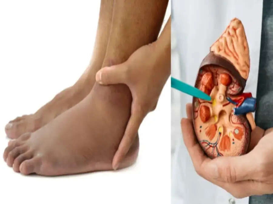 Health Tips-&nbsp;किडनी खऱाब होने पर पैरों में दिखाई देते है ये लक्षण, जानिए इनके बारे में