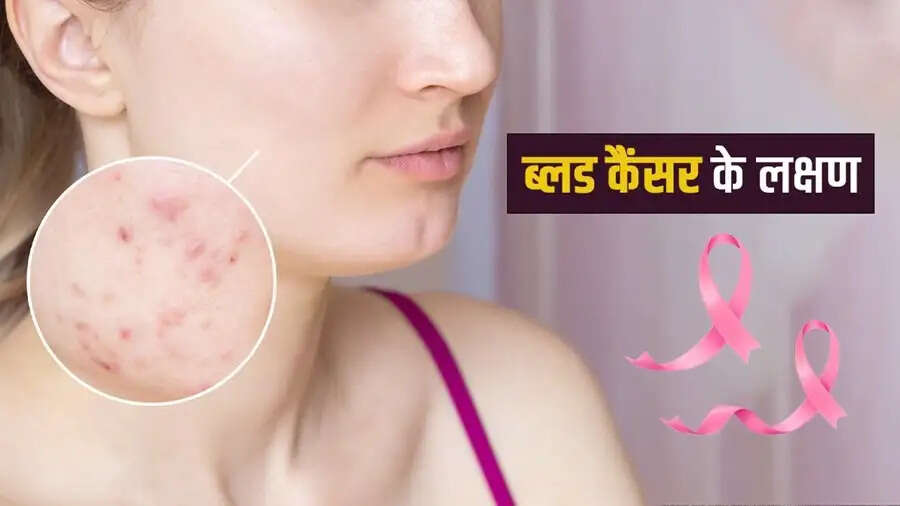 Health Tips-&nbsp; ब्लड कैंसर होने पर दिखाई देते हैं ये लक्षण, जानिए पूरी डिटेल्स