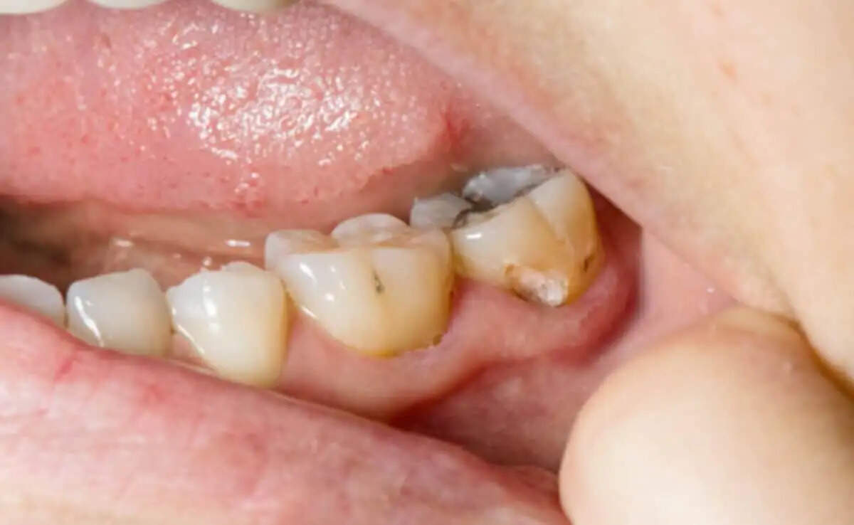 Health Tips- क्या आपको दांतों के कीड़ों ने कर रखा हैं परेशान, तो अपनाएं ये उपाय