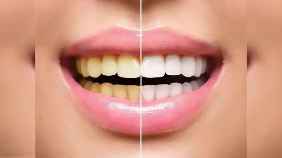 Teeth Care Tips- क्या दांतों के कालेपन से परेशान हैं, इसे हटाने के लिए अपनाएं ये घरेलू टिप्स