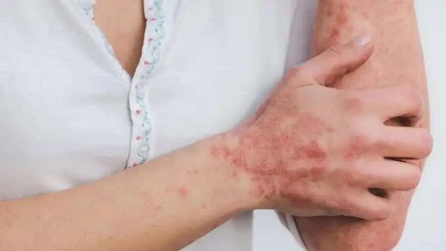 Skin Care&nbsp;Tips-&nbsp;अगर रंग की वजह से त्वचा पर चकते पड़ा जाएं, तो ये नुस्खे अपनाएं
