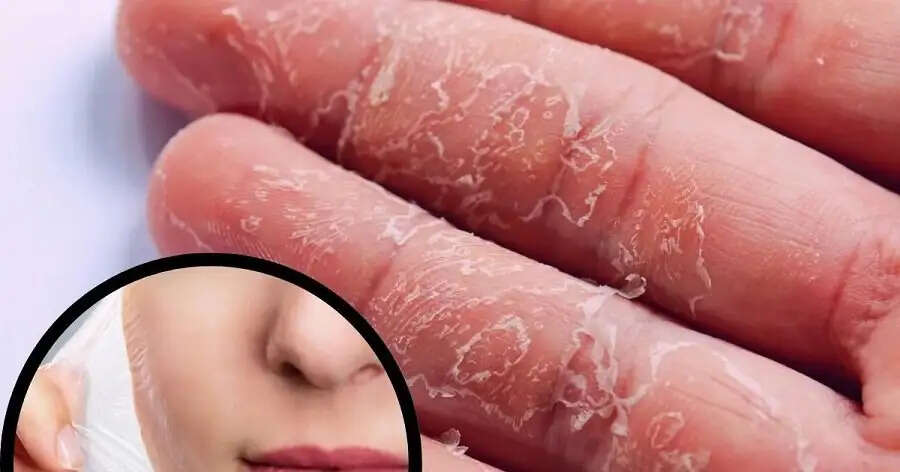 Health Tips- क्या आपके हाथों की हथेली से खाल उतर रही हैं, जान लिजिए इसके कारण