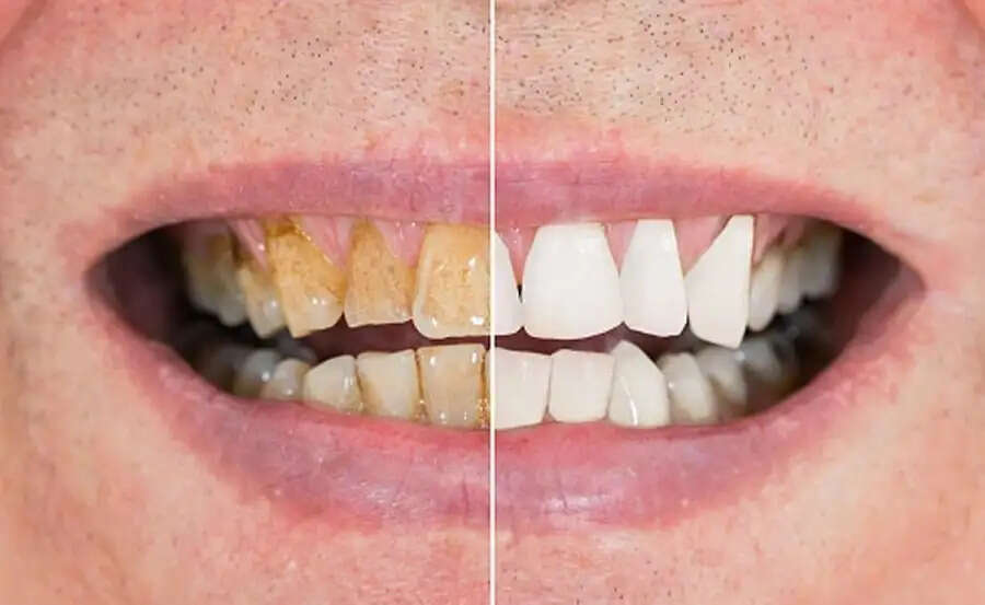 Teeth Care Tips-&nbsp;क्या आपके दांत पीले हो गए हैं, सफेद दांत पाने के लिए अपनाएं ये टिप्स