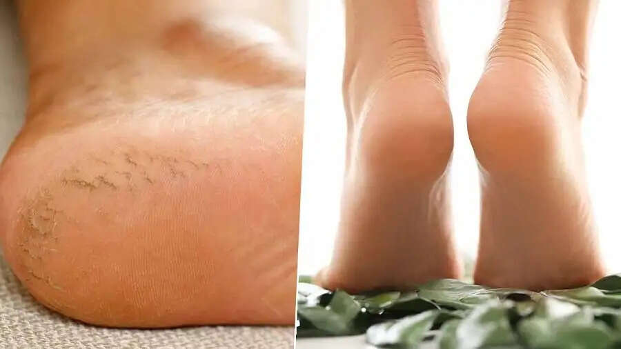 Crack Ankle Tips-&nbsp;क्या हर मौसम में आपकी एड़ियां फटी रहती हैं, तो शरीर में इन विटामिन की हो सकती हैं कमी