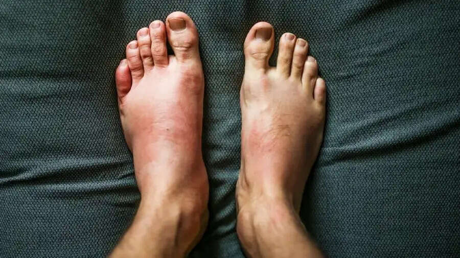 Health Tips-  क्या आपका शरीर बिना किसी वजह के फूल रहा हैं, तो इस बीमारी का हो सकता हैं खतरा