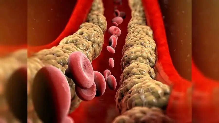 Health Tips-&nbsp;शरीर में कोलस्ट्रॉल बढ़ने पर दिखाई देते हैं ये लक्षण, जानिए इनके बारे में