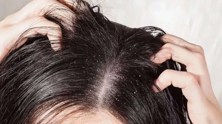 Hair Care Tips- बारिश की वजह से बालों में डैंड्रफ हो गया है, ऐसे पाएं छुटकारा