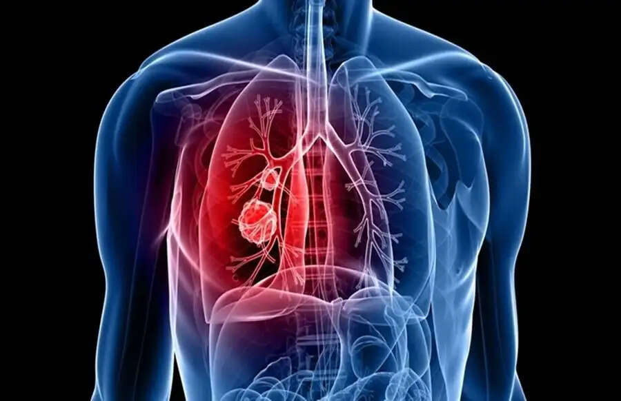 Lungs Health Tips – प्रदूषण के कारण फेफड़ें कमजोर हो गए हैं, हेल्दी बनाए रखने के लिए अपनाएं ये टिप्स