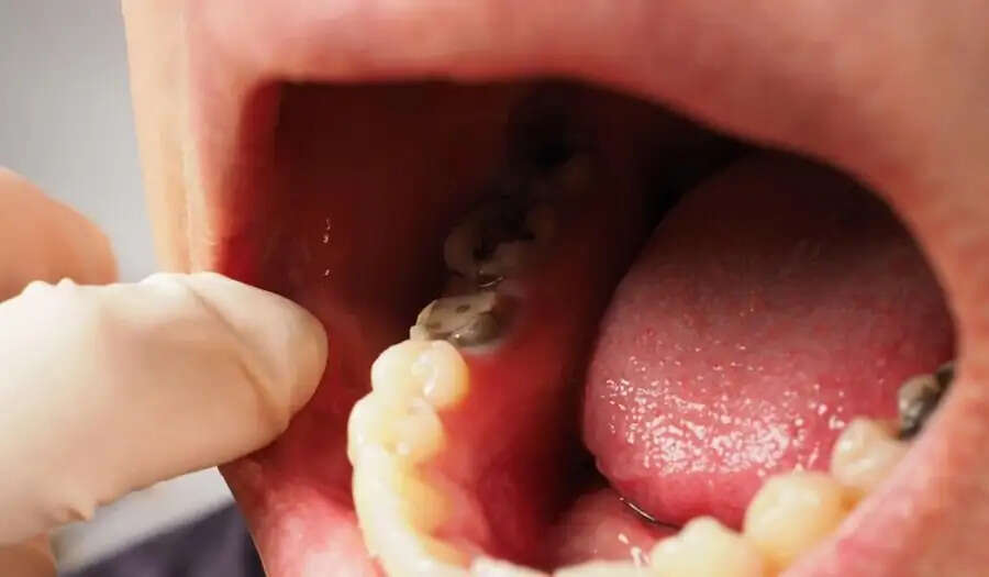 Teeth Care Tips-&nbsp;क्या दांतों की कैविटी से परेशान हैं, ऐसे पाएं छुटकारा