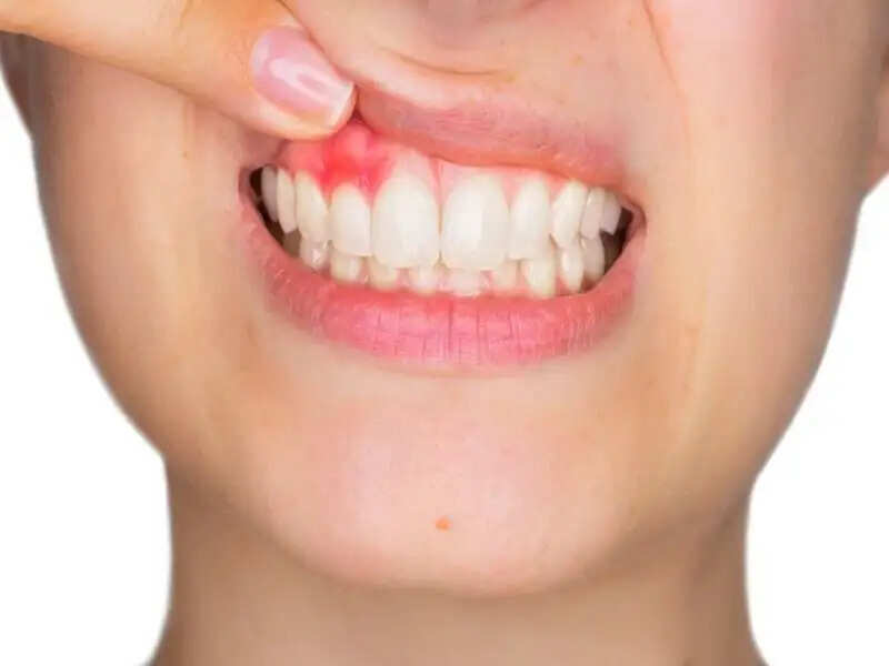 Teeth Care Tips- मसूड़ों को बनाना हैं मजबूत, तो इन चीजों का करें इस्तेमाल