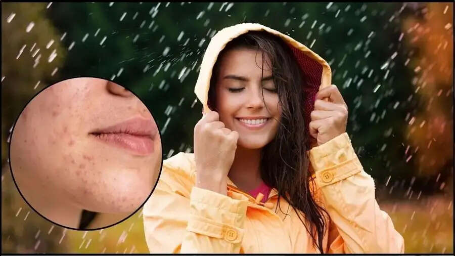 Skin Care Tips-बारिश के पानी की वजह से हो सकता है फंगल इंफेक्शन, जानिए इसके लक्षण