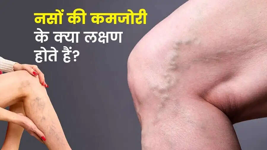 Health Tips-&nbsp;नसों में होने वाली ये बीमारी होती है जानलेवा, जानिए इसके लक्षण