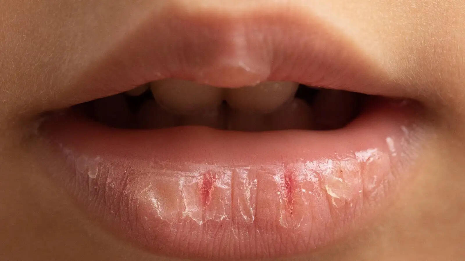 Lips Care Tips- क्या ठंड की वजह से आपके होंठ फट गए हैं, तो अपनाएं ये घरेलू उपाय