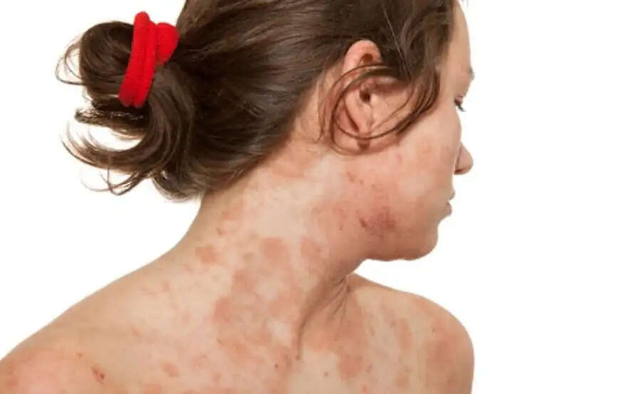 Face Care Tips-&nbsp;क्या आपके चेहरे पर हो रही हैं खुजली, तो ऐसे करें इसका इलाज