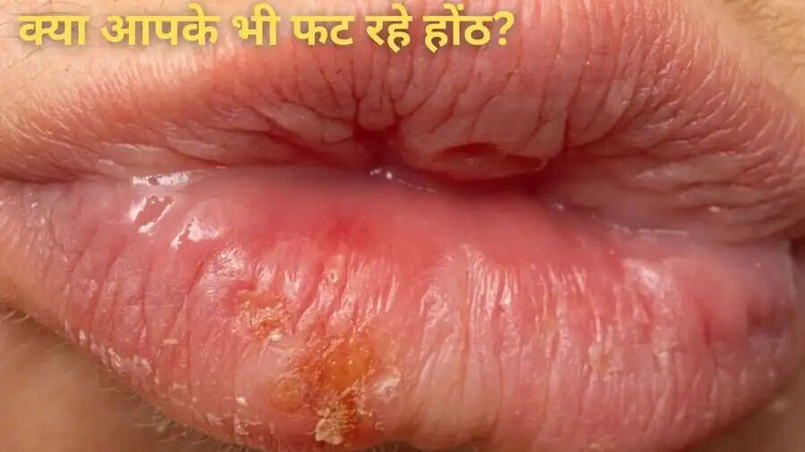 Lips Care Tips-  क्या तेज गर्मी के कारण आपके होंठ फट गए हैं, मुलायम बनाने के लिए अपनाएं ये तरीके