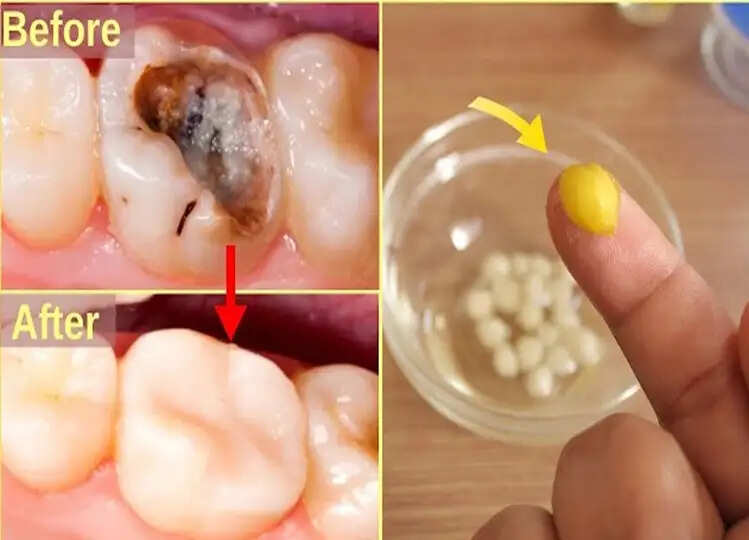 2 रुपए के खर्चे से दांतों में लगे कीड़े आ जाएंगे बाहर, जानें ये कारगर उपाय