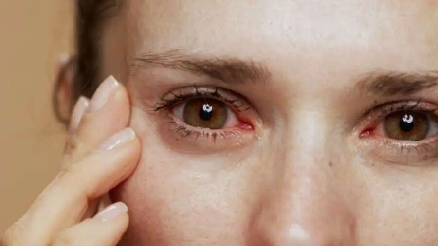 Eye Care Tips- क्या आपकी आंखों में&nbsp;धुंधलापन और ड्राइनेस की समस्या हो गई हैं, तो इन चीजों का करें इस्तेमाल