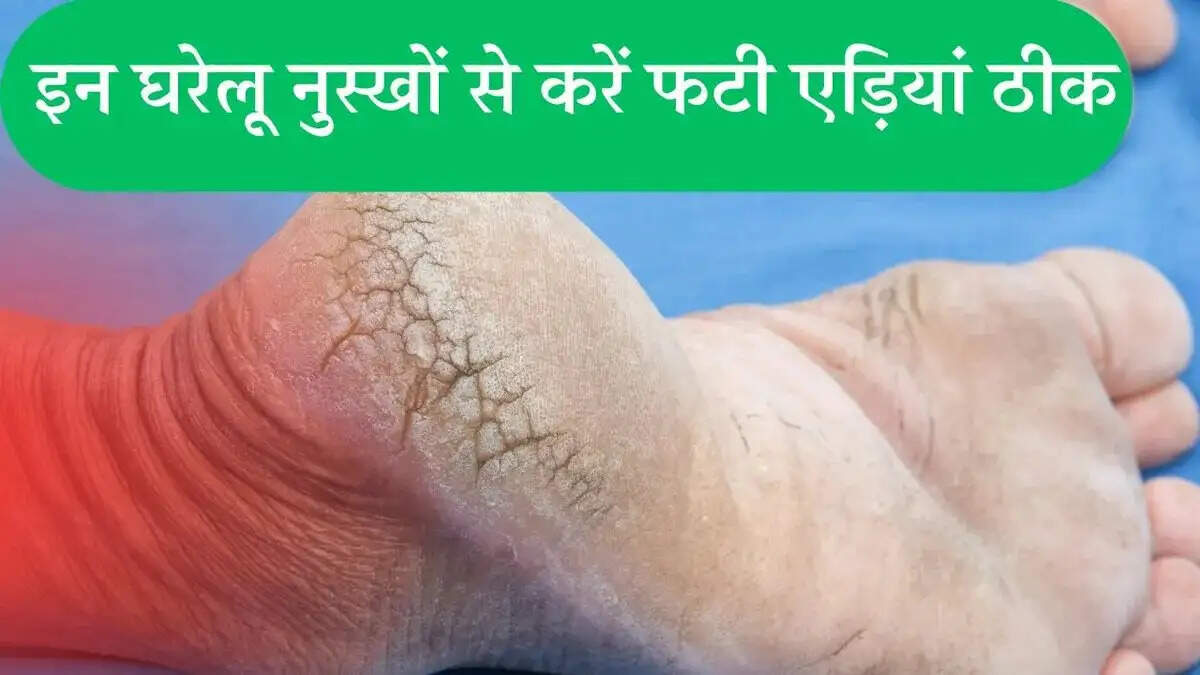Cracked Heel Remedies- क्या सर्दी की वजह से एड़ियां फट गई हैं, इन्हें सॉफ्ट बनाने के लिए अपनाएं ये उपाय