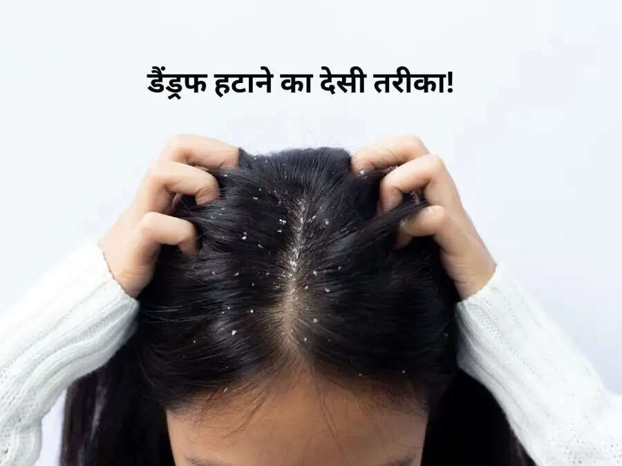 Hair Care Tips-&nbsp;क्या हेवी डैंड्रफ ने परेशान कर रखा है, तो ऐसे करें इसे कम
