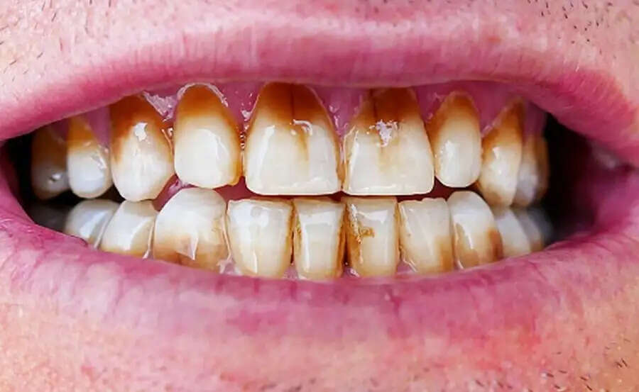 Teeth Care Tips-&nbsp;पीले दांतों को चमकाने के लिए अपनाएं ये तरीके, आइए जानें इनके बारे में