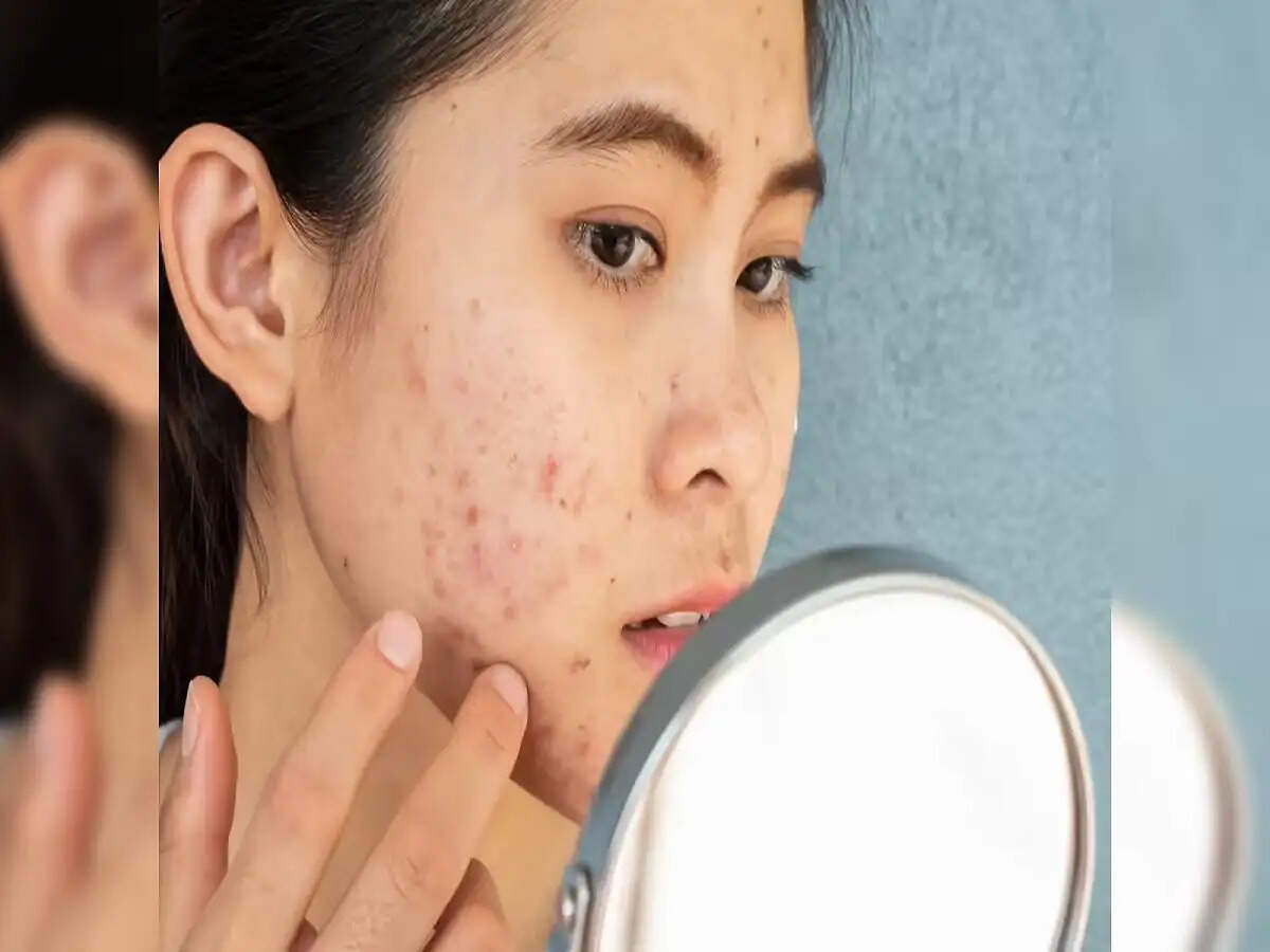 Oily Skin Mistakes: ऑयली स्किन से ग्रसित लोग भूलकर भी न लगाएं ये चीजें, पिंपल्स की हो जाएगी बरसात