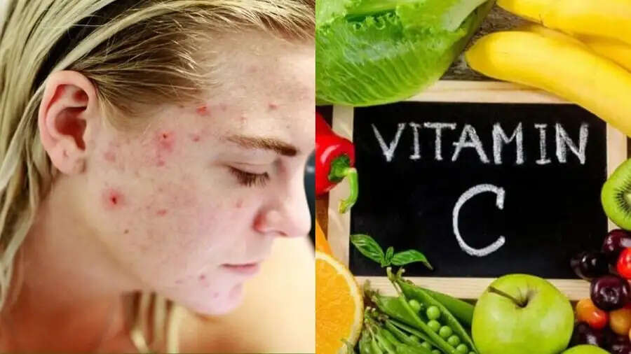 Health Tips-&nbsp;शरीर में विटामिन C&nbsp;की कमी हो गई हैं, तो ऐसे करें पूर्ती