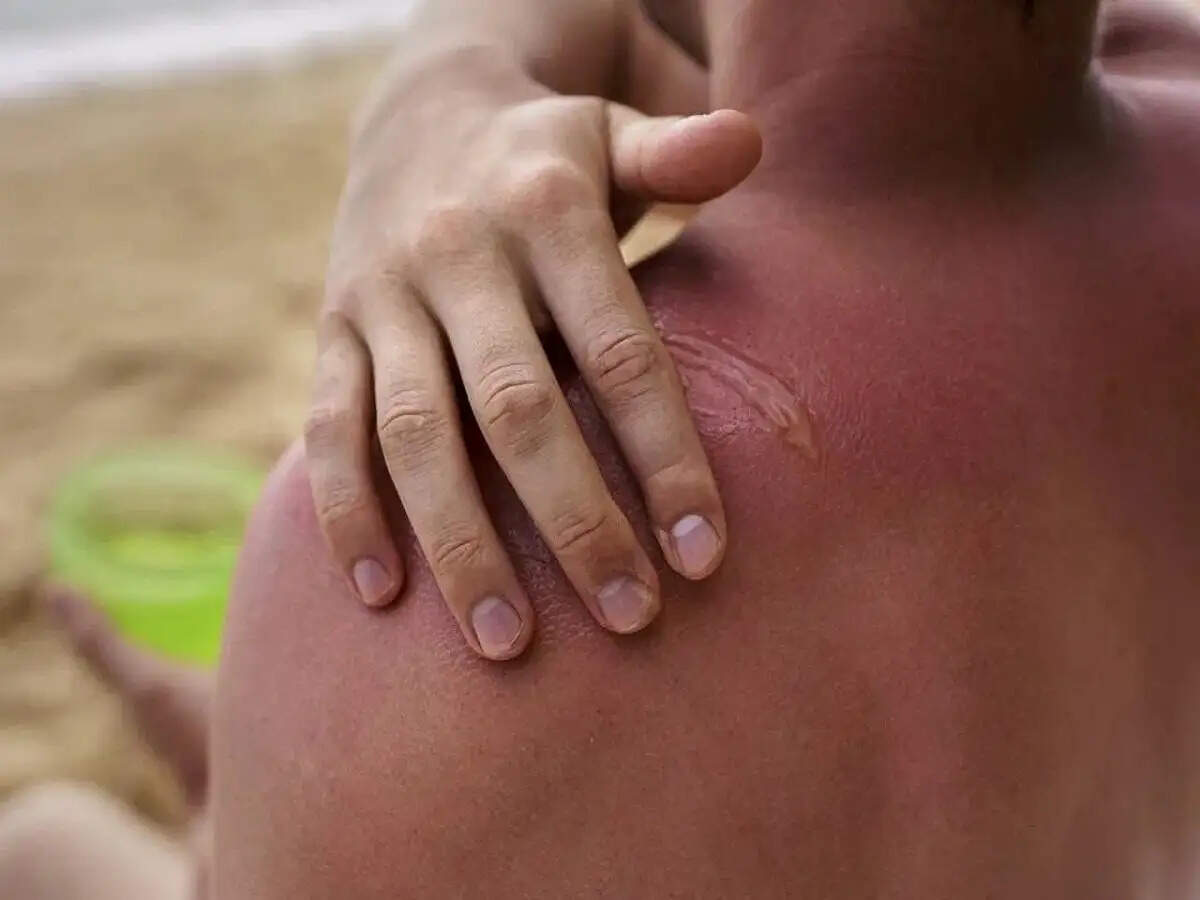 Summer Care Tips- क्या आपका बच्चा घमौरियों से परेशान हैं, इन तरीकों से दिलाए राहत