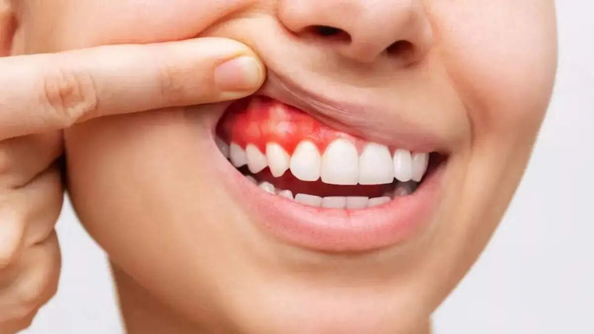 Teeth Care Tips- मसूड़ों से बह रहा हैं खून और सड़न ने कर रखा है परेशान, तो अपनाएं ये घरेलू नुस्खें