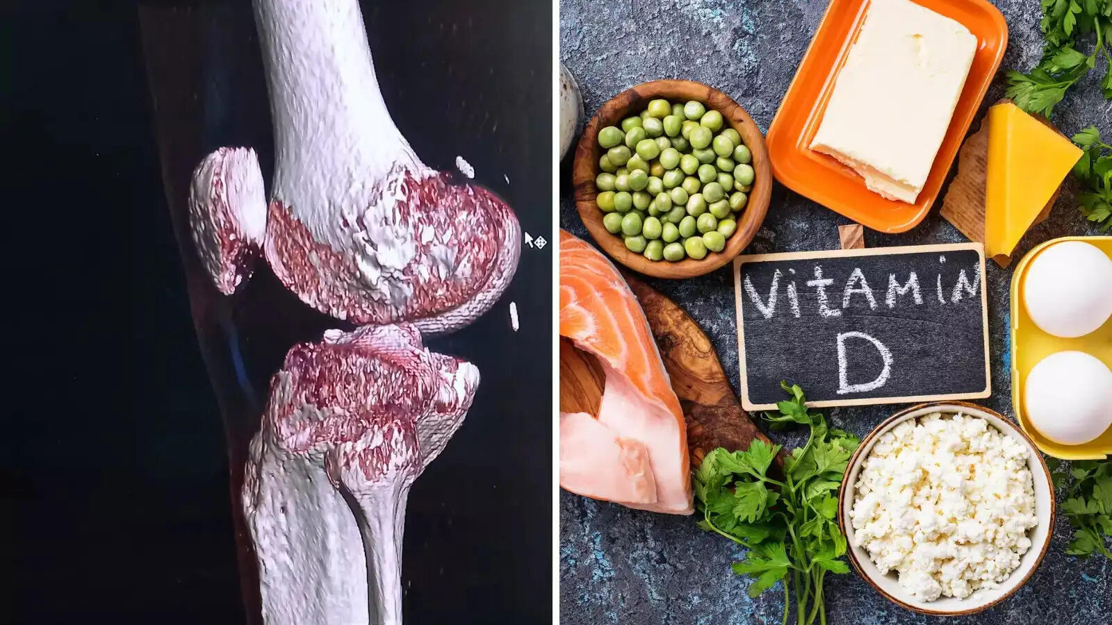 Health Tips- शरीर में विटामिन डी कमी होने पर दिखाई देते हैं लक्षण, आहार में शामिल करें ये चीजें