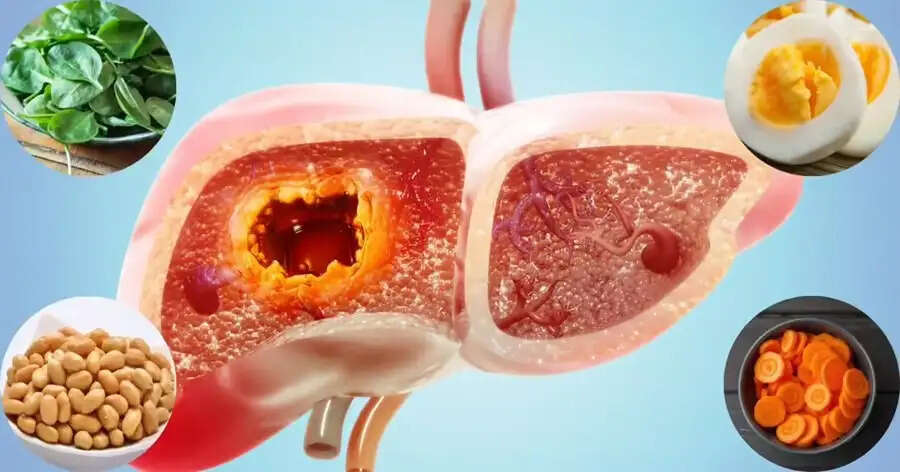 Health Tips-&nbsp;क्या आप फैटी लिवर से परेशान हैं, तो इन चीजों का भूलकर भी ना करें सेवन
