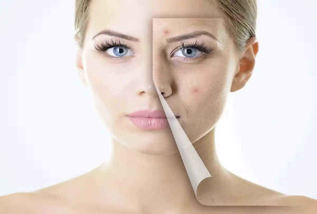 Beauty Tips- चेहरे की खूबसूरती को कम कर रहे हैं मंहासे और झाइयों के दाग, ऐसे पाएं छुटकारा