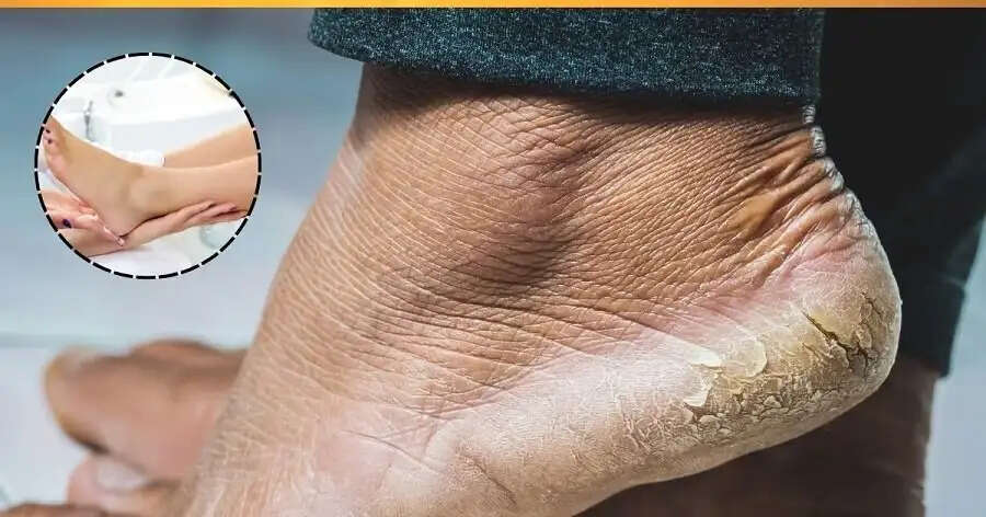 Crack Heals- क्या गर्मी में भी आपकी एड़ियां, तो अपनाएं ये देसी नुस्खें
