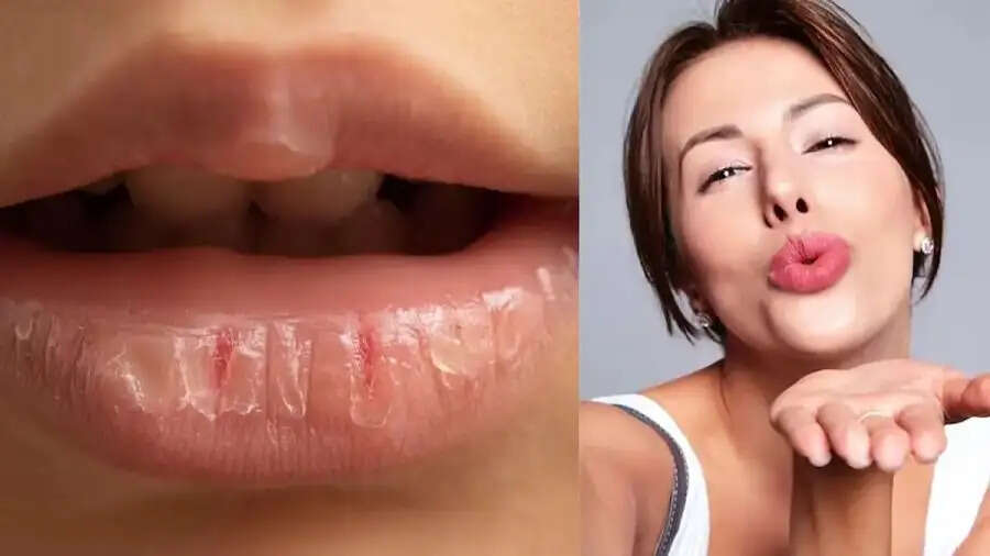 Lips Care Tips-&nbsp;ठंड की वजह से होँठ फट गए हैं, तो उनका ऐसे रखें ख्याल