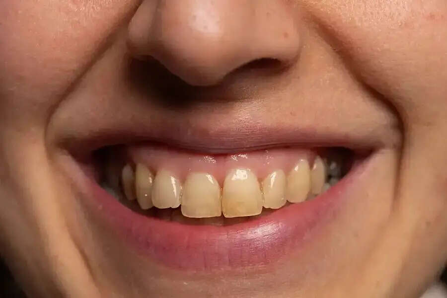 Teeth Care Tips- शरीर में इस विटामिन की कमी से दांत हो जाते हैं पीले, जानिए इसके बारे में