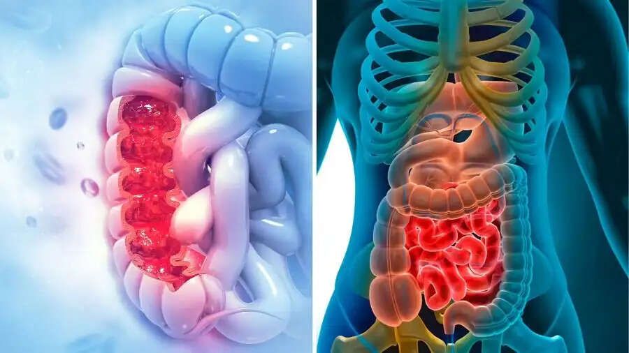 Health Tips-&nbsp;कोलन कैंसर होने पर दिखाई देते हैं ये लक्षण, जानिए पूरी डिटेल्स
