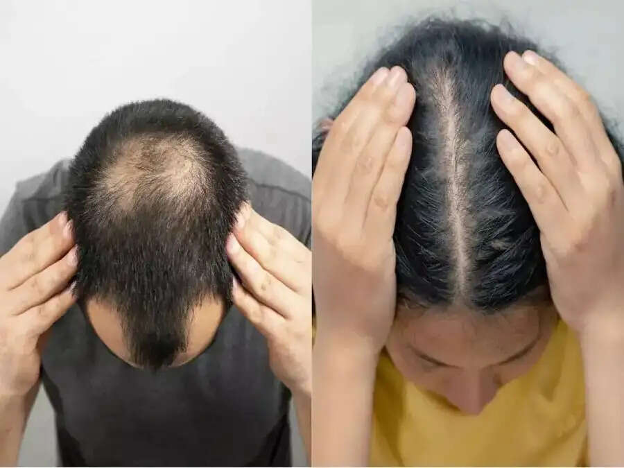 Hair Care Tips- क्या जवानी में ही गंजेपन का हो रहे हैं शिकार, तो इन आदतों से रहे दूर